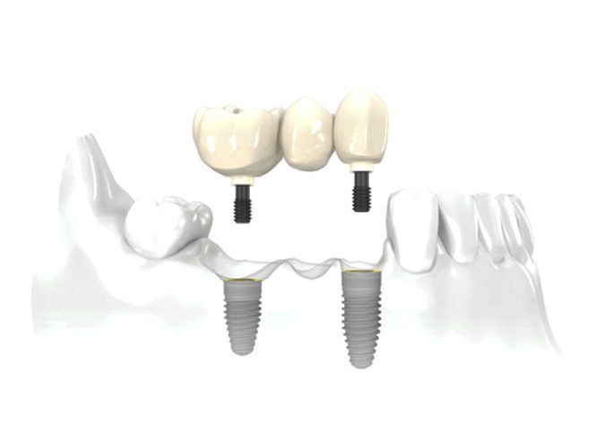 Implantes De Varios Dientes